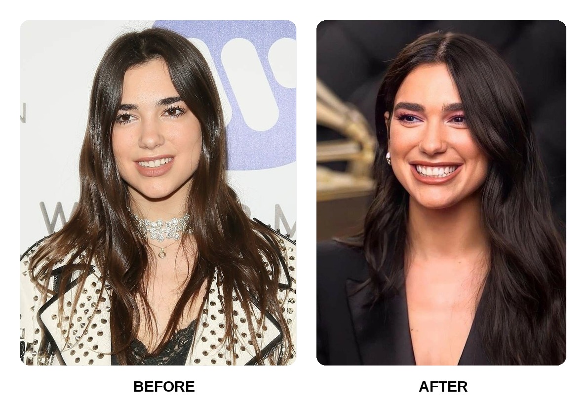 Dua Lipa Teeth Before and After: What Happened in Her Transformation?