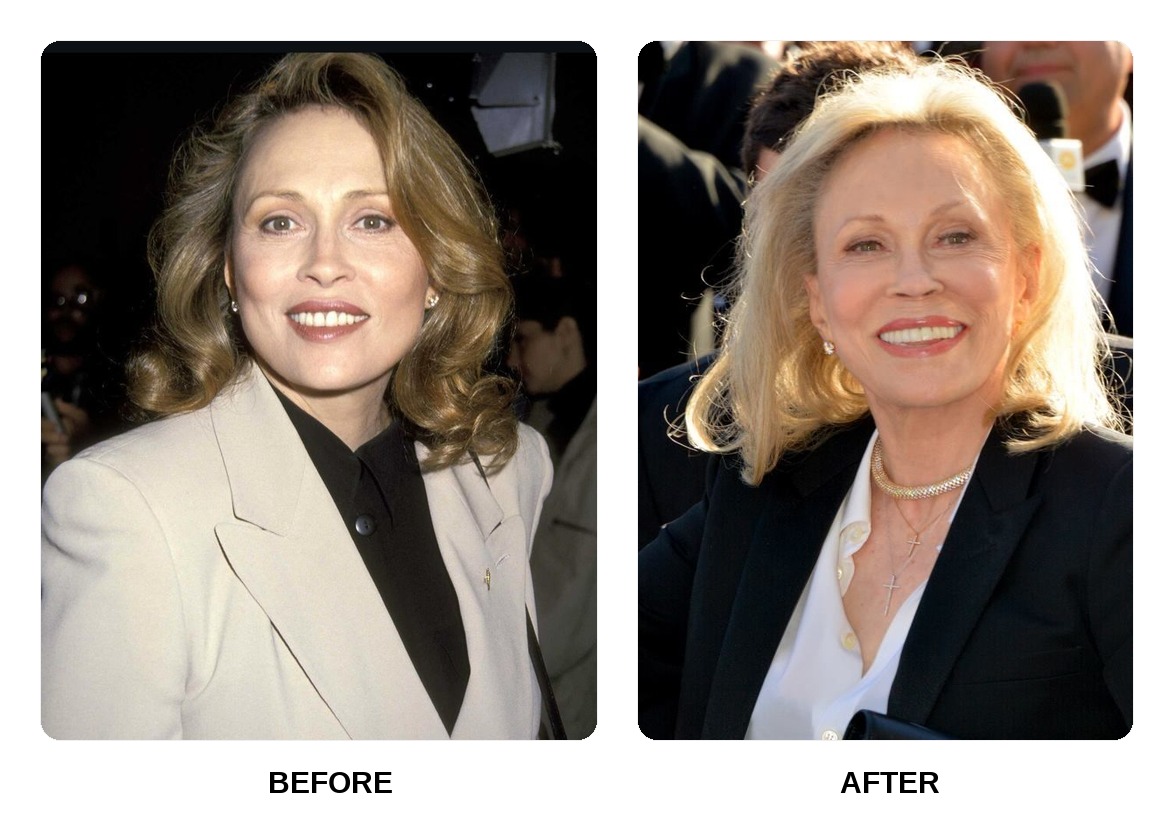 Faye Dunaway Teeth Before and After: What Happened in Her Transformation?