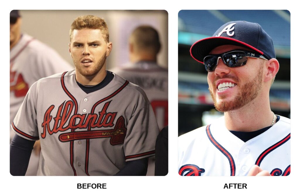 Freddie Freeman Teeth Before and After: What Happened in His Transformation?