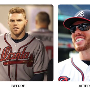 Freddie Freeman Teeth Before and After: What Happened in His Transformation?