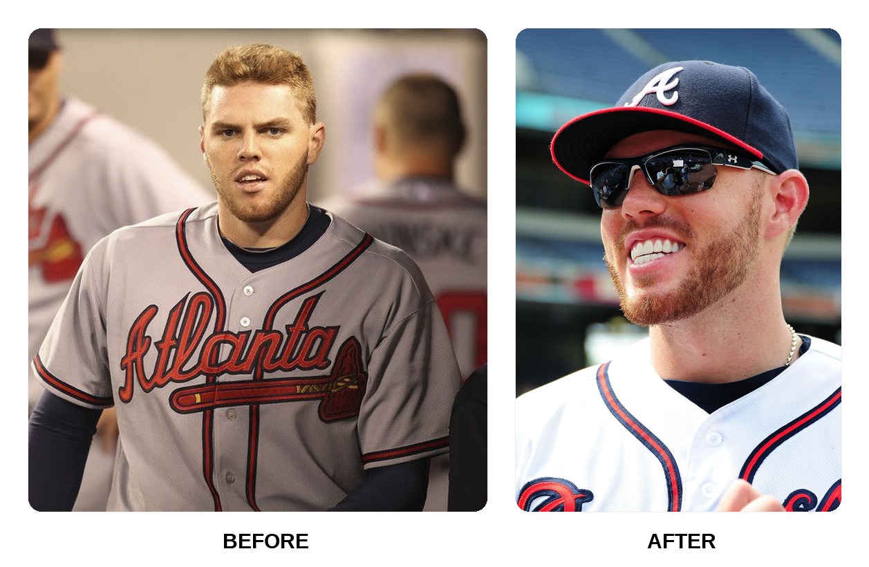 Freddie Freeman Teeth Before and After: What Happened in His Transformation?