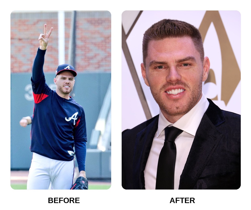 Freddie Freeman teeth in his youth