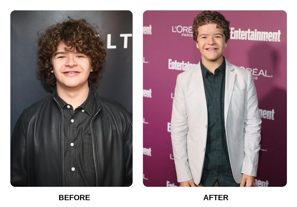 Gaten Matarazzo Teeth Before and After: What Happened in His Transformation?