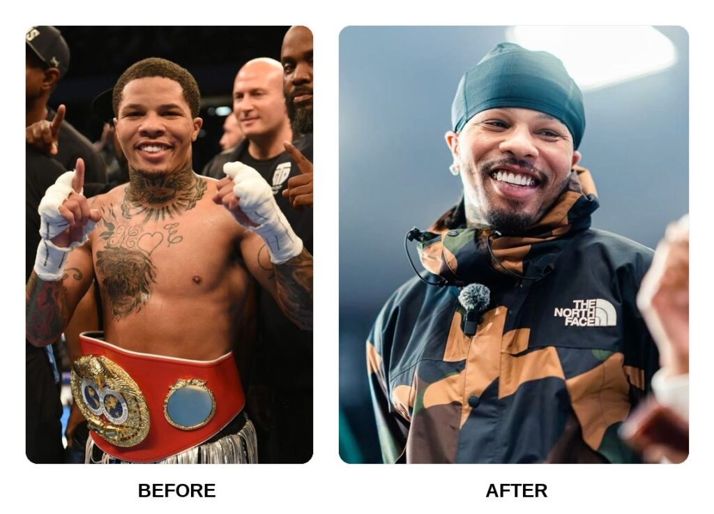 Gervonta Davis Teeth Before and After: What Happened in His Transformation?