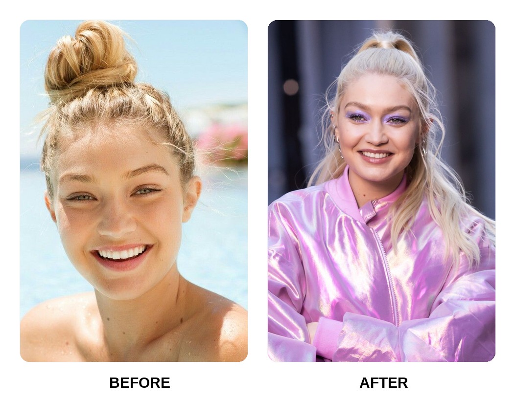 Gigi Hadid Teeth Before and After: What Happened in Her Transformation?
