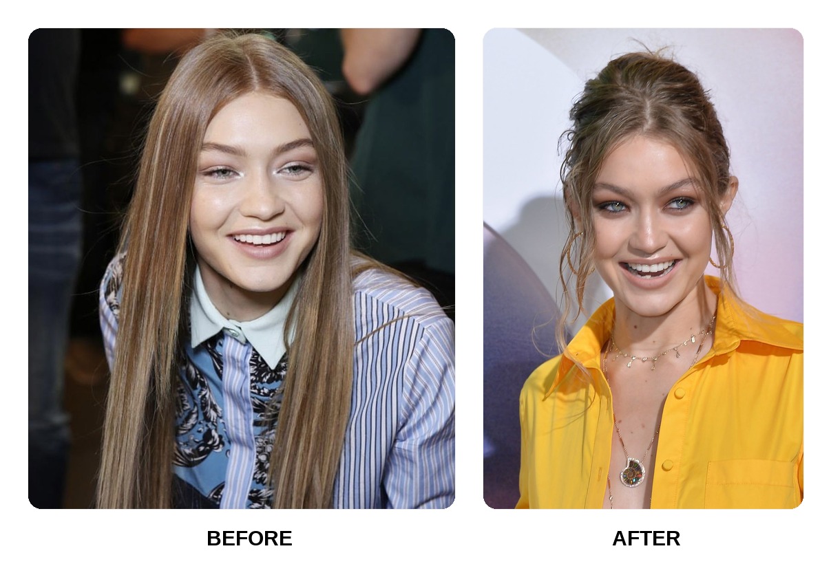 Gigi Hadid teeth in her youth