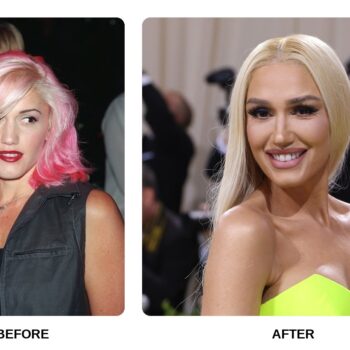 Gwen Stefani Teeth Before and After: What Happened in Her Transformation?