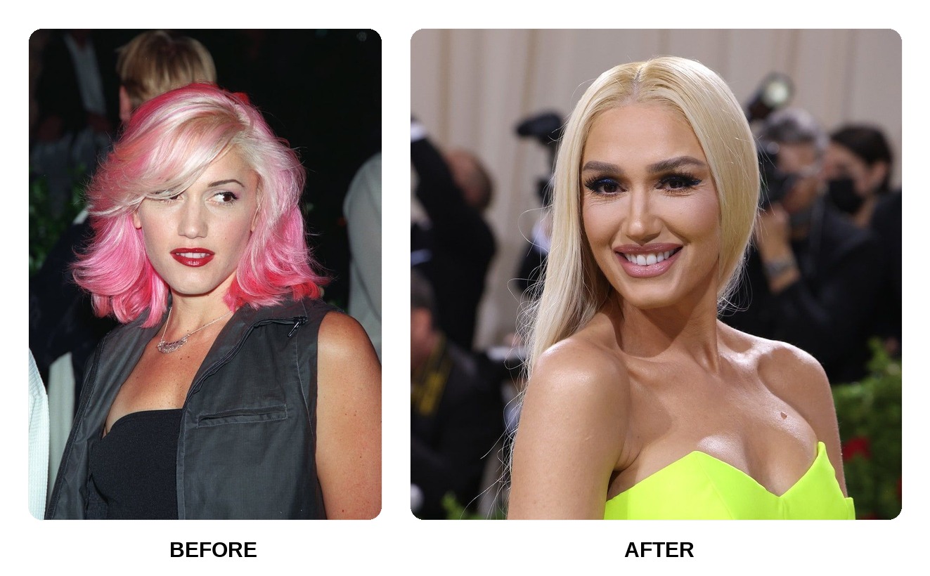 Gwen Stefani Teeth Before and After: What Happened in Her Transformation?