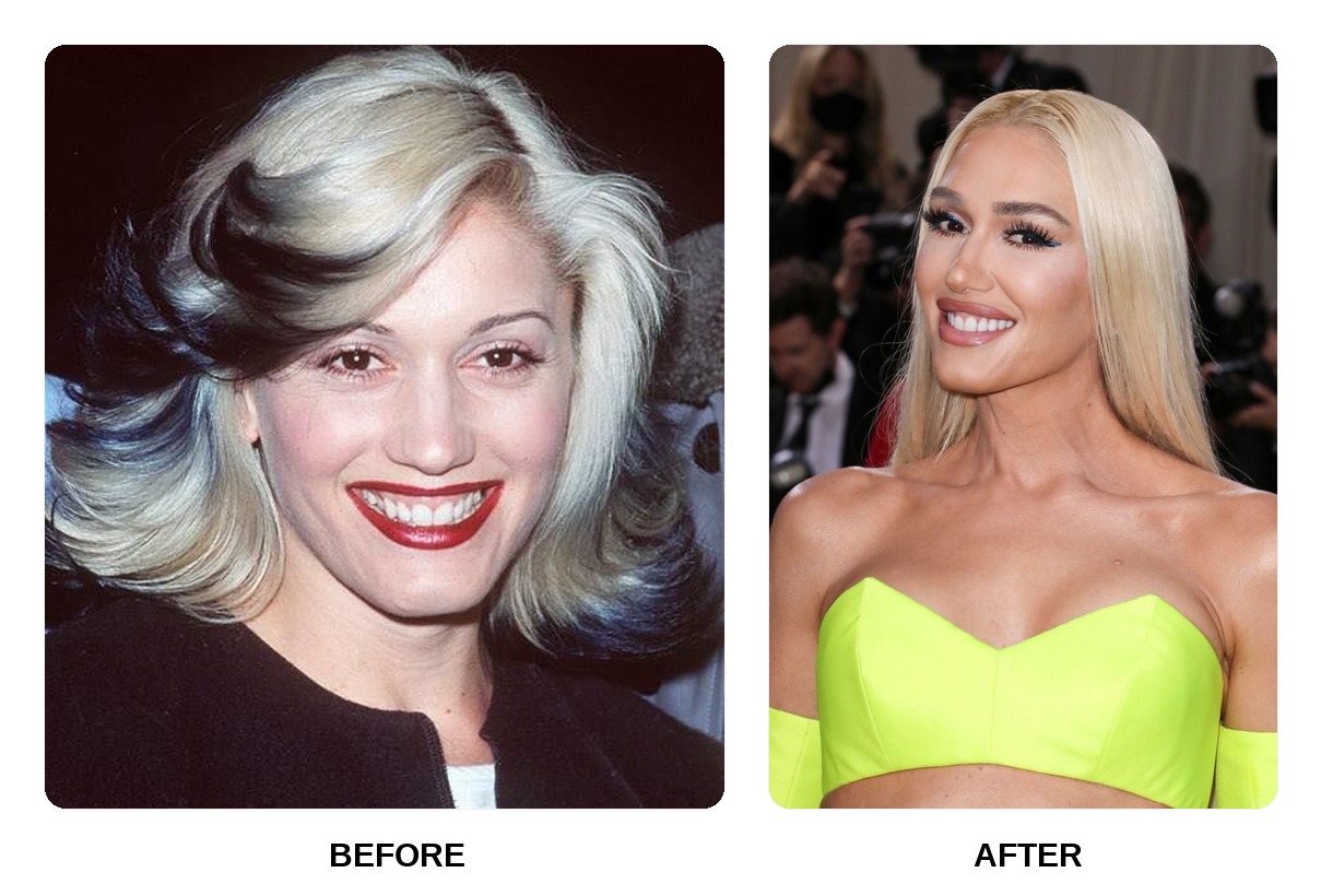Gwen Stefani teeth in her youth