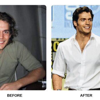 Henry Cavill Teeth Before and After: What Happened in His Transformation?