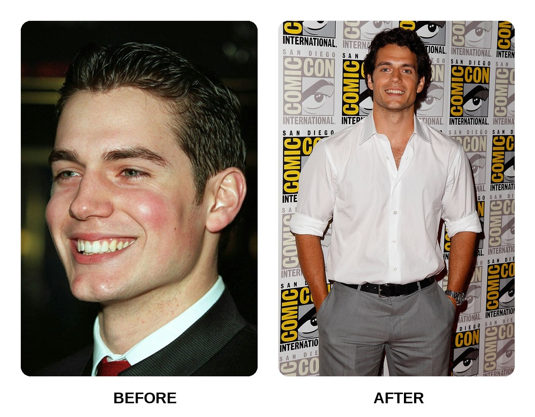 Henry Cavill teeth in his youth