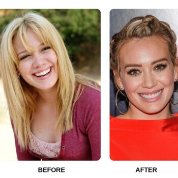 Hilary Duff Teeth Before and After: What Happened in Her Transformation?