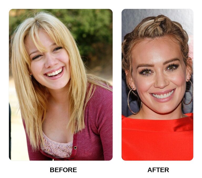 Hilary Duff Teeth Before and After: What Happened in Her Transformation? -  Dental Treatment in Turkey - Europe Dental Clinic