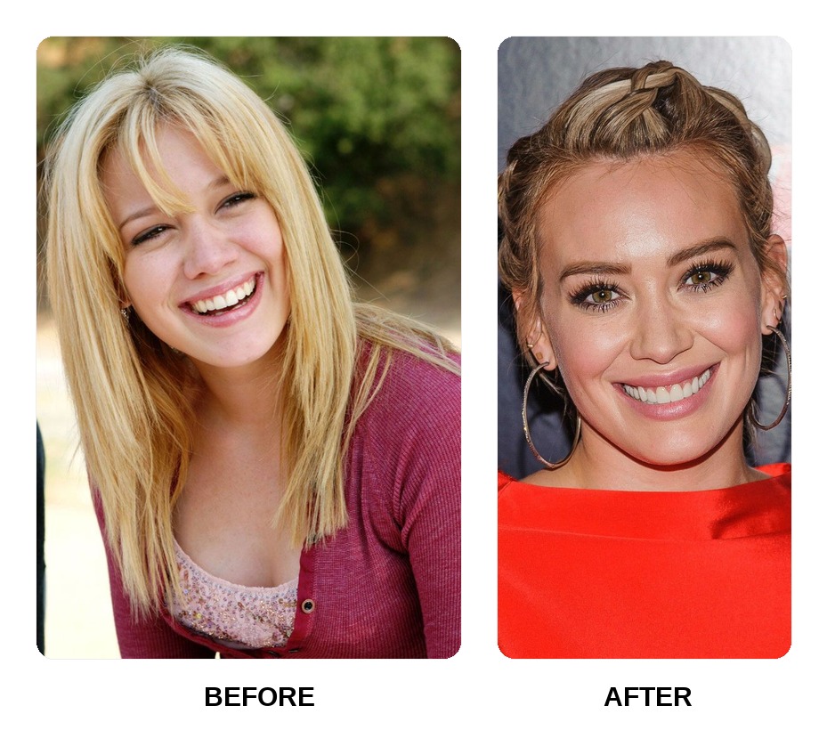 Hilary Duff Teeth Before and After: What Happened in Her Transformation?