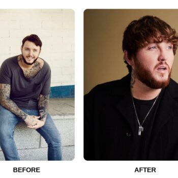 James Arthur Teeth Before and After: What Happened in His Transformation?