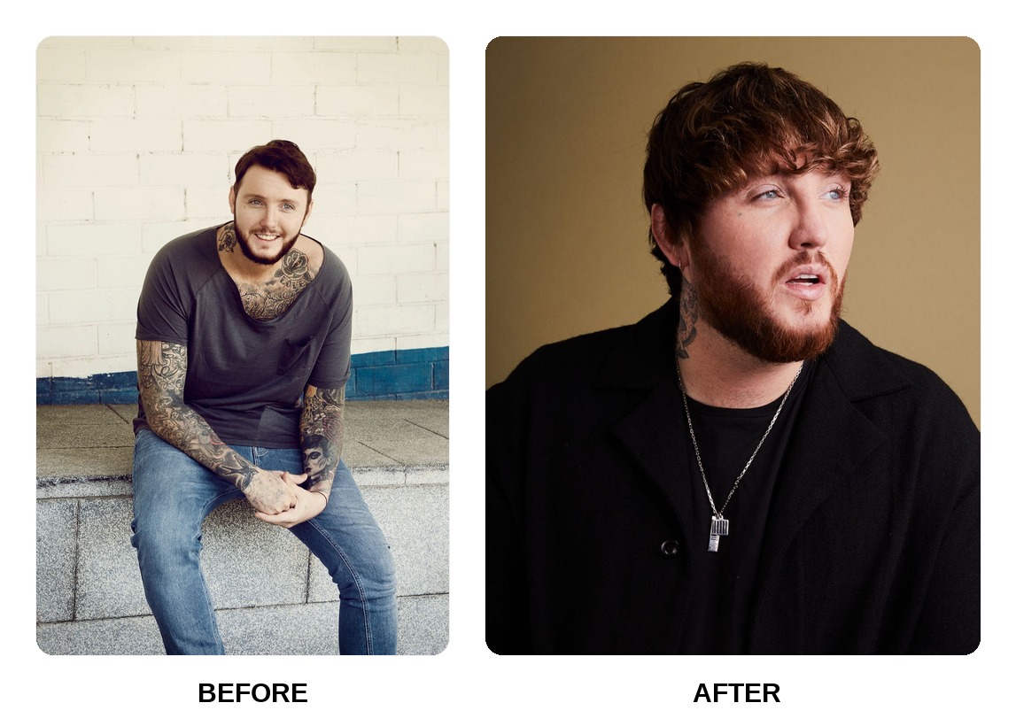 James Arthur Teeth Before and After: What Happened in His Transformation?