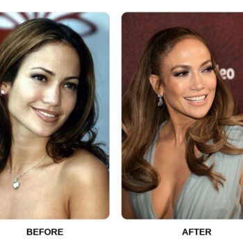 Jennifer Lopez Teeth Before and After: What Happened in Her Transformation?
