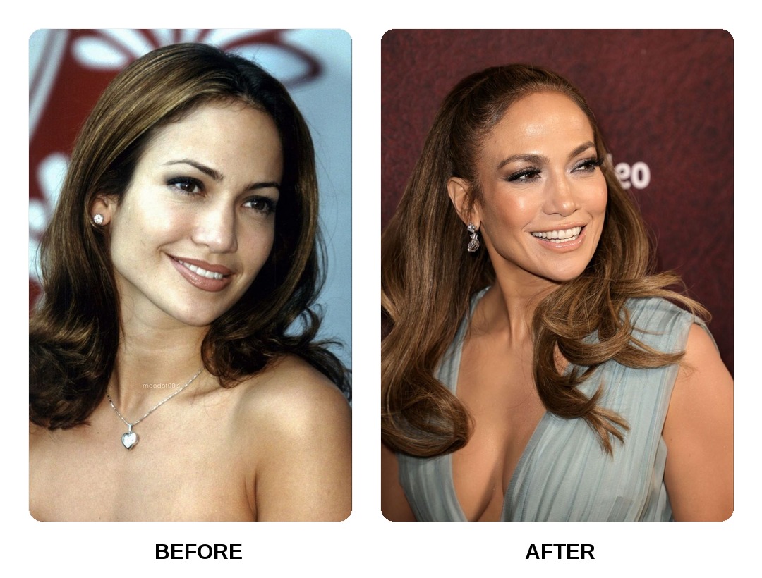 Jennifer Lopez Teeth Before and After: What Happened in Her Transformation?