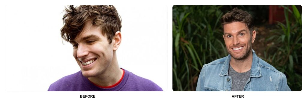 Joel Dommett Teeth Before and After: What Happened in His Transformation?
