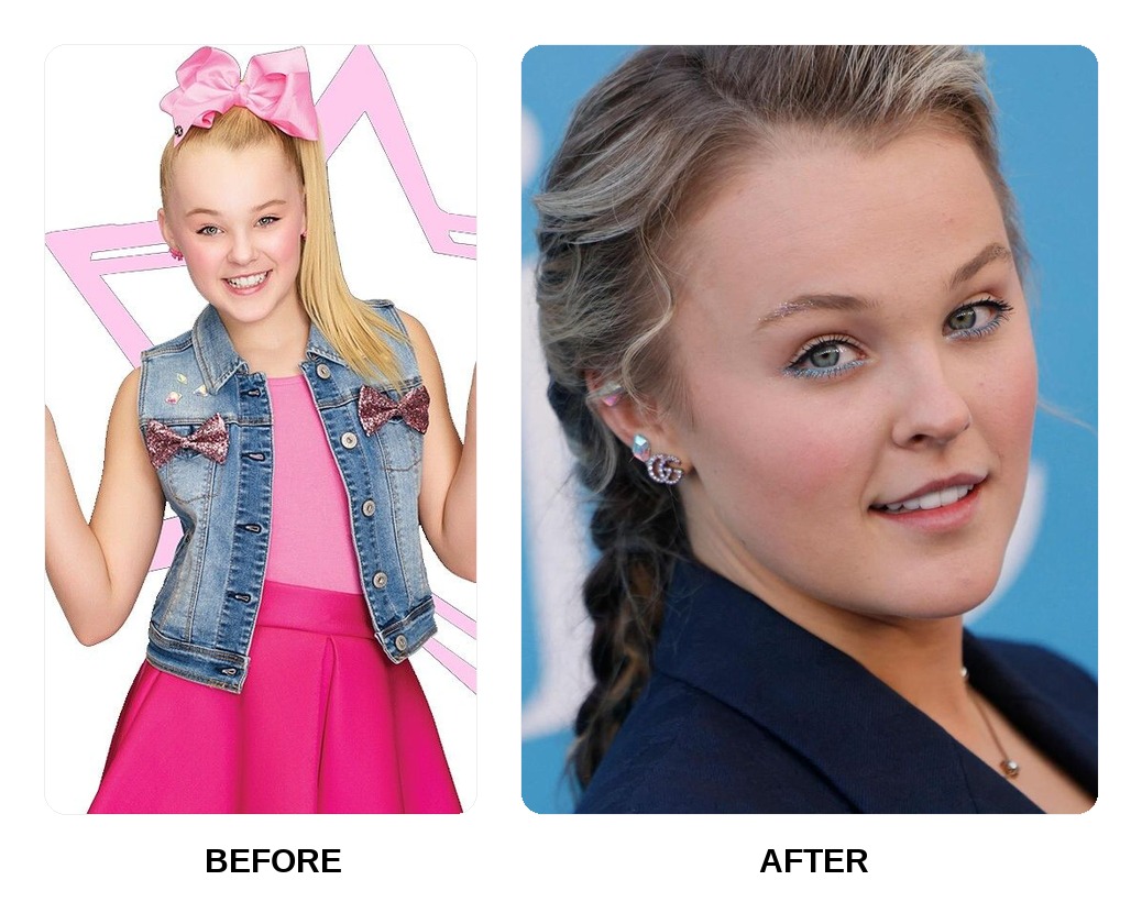 Jojo Siwa Teeth Before and After: What Happened in Her Transformation?