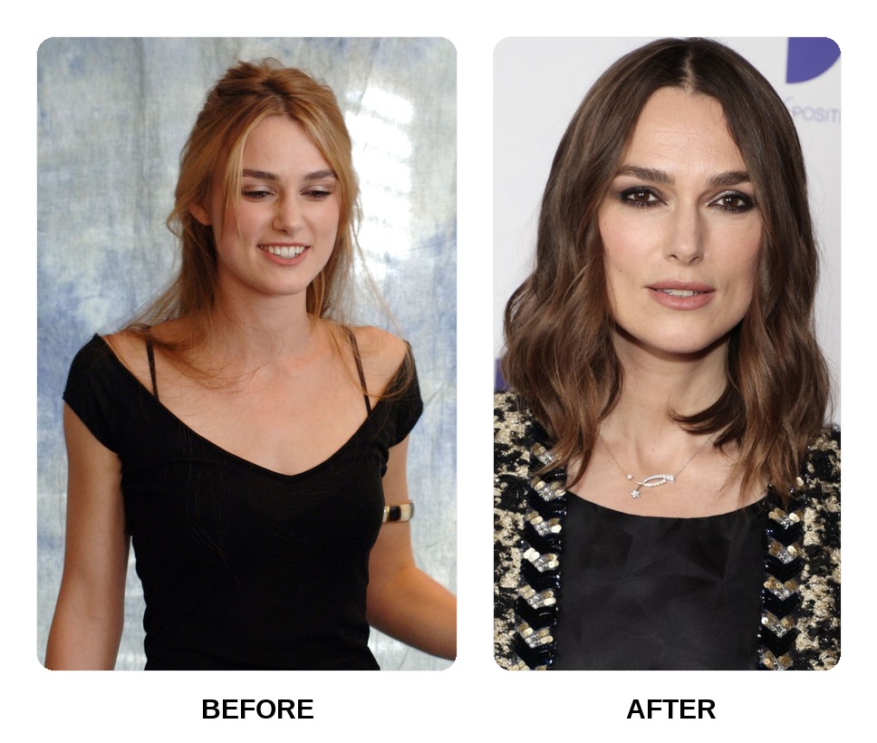 Keira Knightley Teeth Before and After: What Happened in His Transformation?