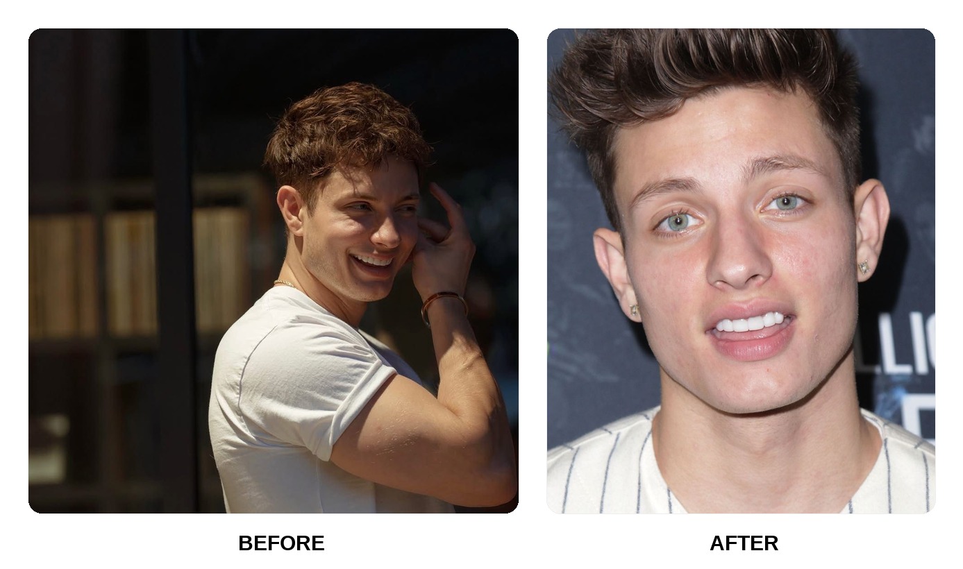 Matt Rife teeth in his youth