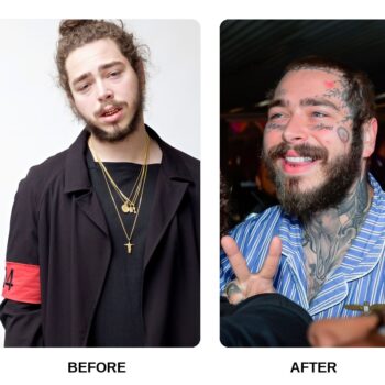 Post Malone Teeth Before and After: What Happened in His Transformation?