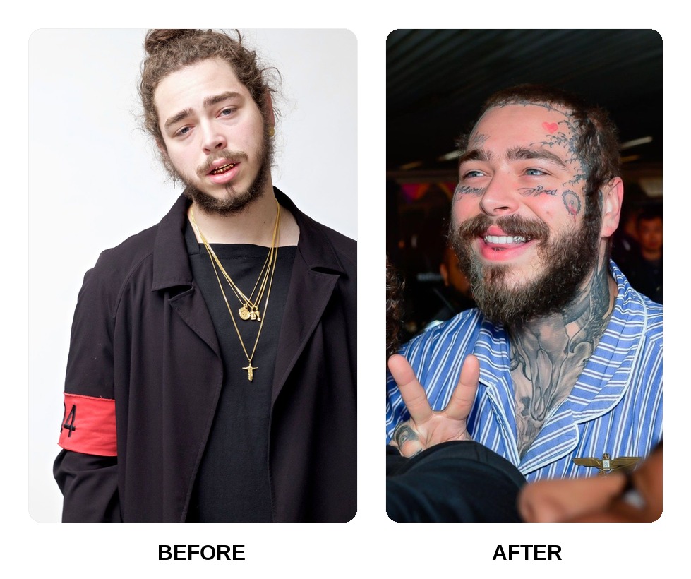 Post Malone Teeth Before and After: What Happened in His Transformation?