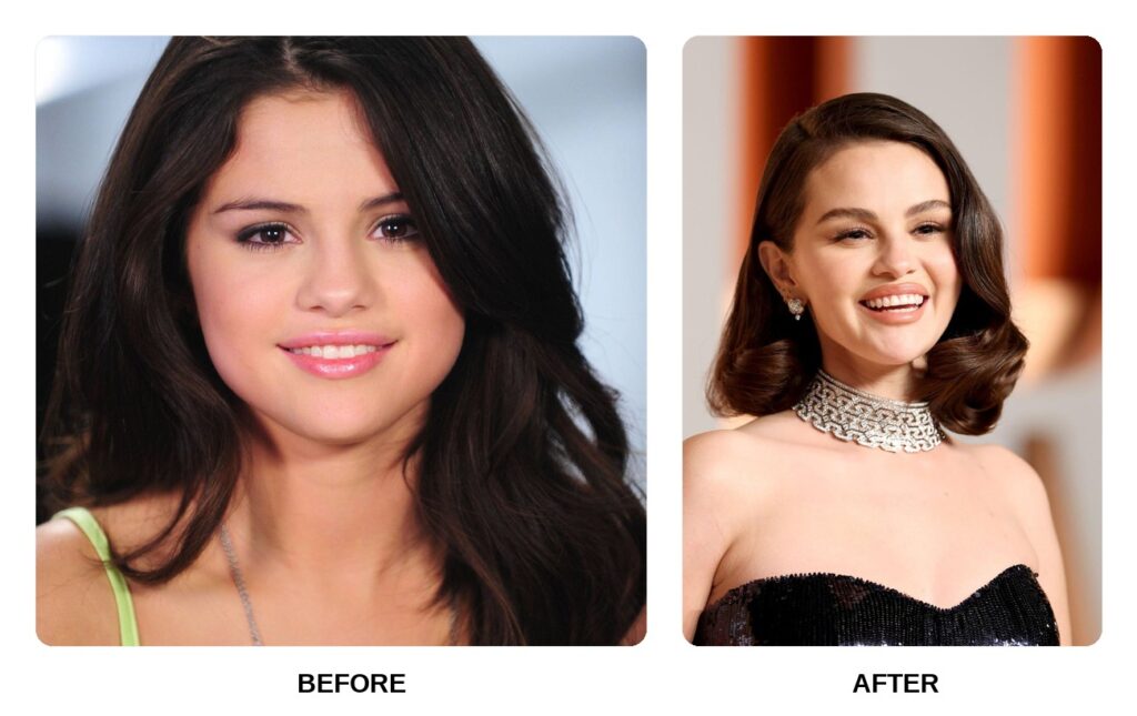 Selena Gomez Teeth Before and After: What Happened in His Transformation?