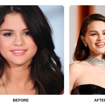 Selena Gomez Teeth Before and After: What Happened in His Transformation?