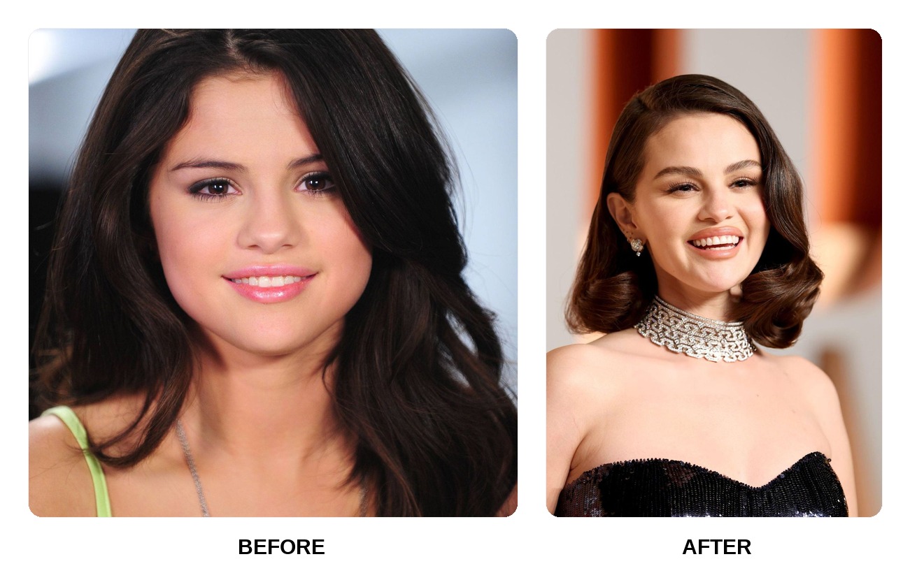Selena Gomez Teeth Before and After: What Happened in His Transformation?