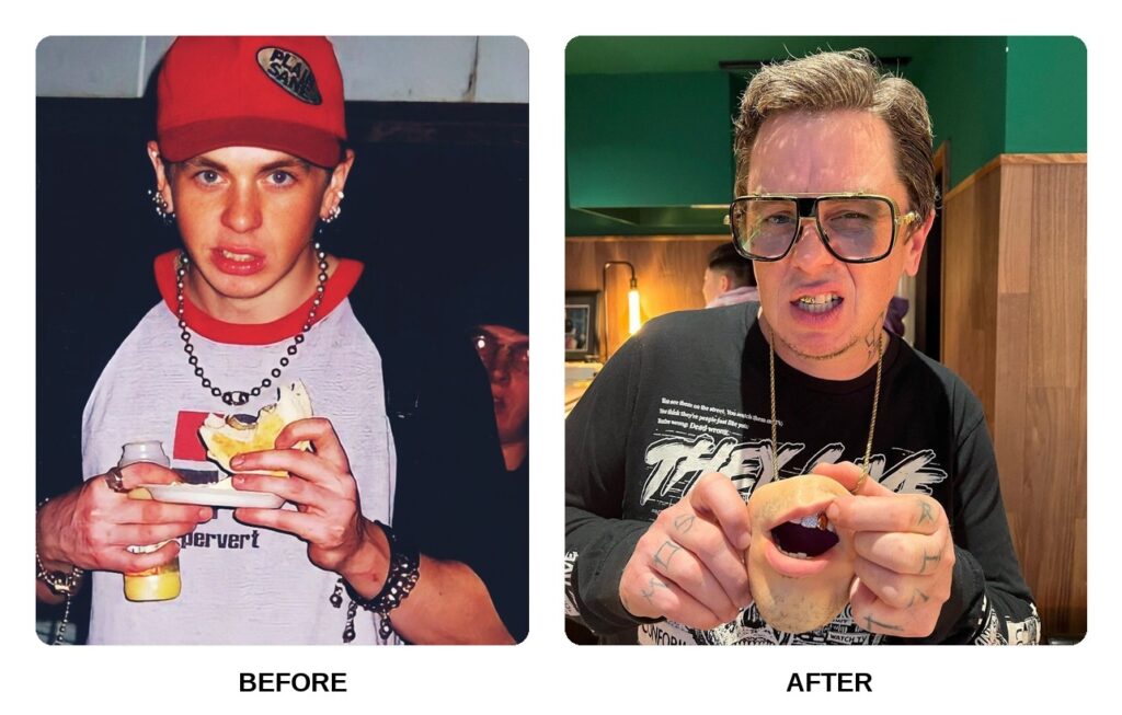 Sid Wilson Teeth Before and After: What Happened in His Transformation?
