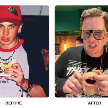 Sid Wilson Teeth Before and After: What Happened in His Transformation?
