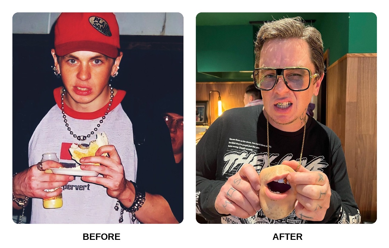 Sid Wilson Teeth Before and After: What Happened in His Transformation?