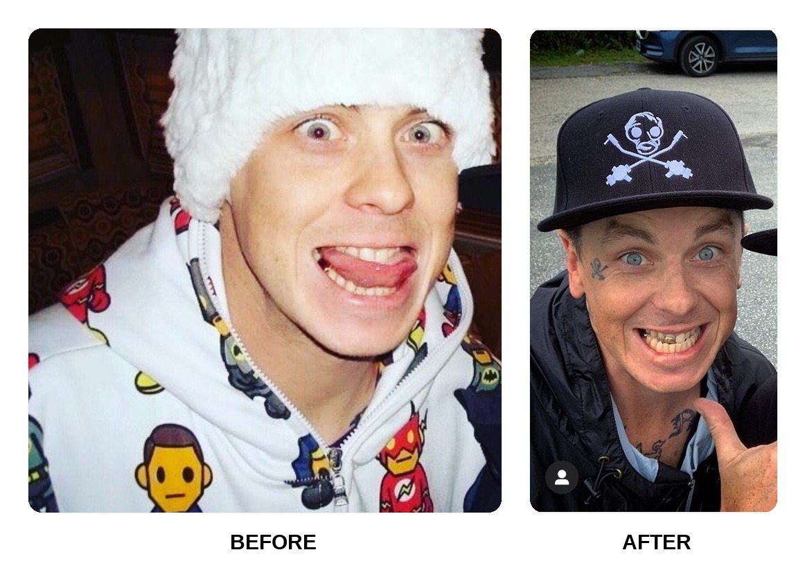 Sid Wilson teeth in his youth
