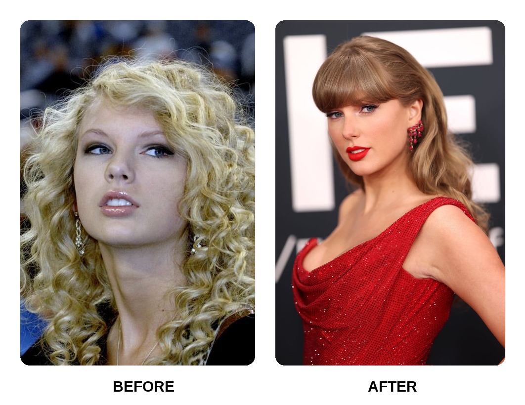 Taylor Swift Teeth Before and After: What Happened in His Transformation?