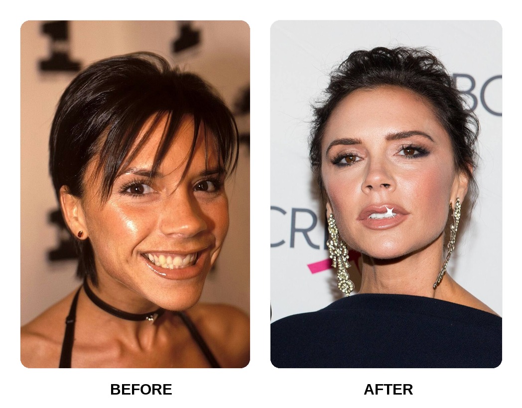 Victoria Beckham’s Teeth Before and After: What Happened in His Transformation?