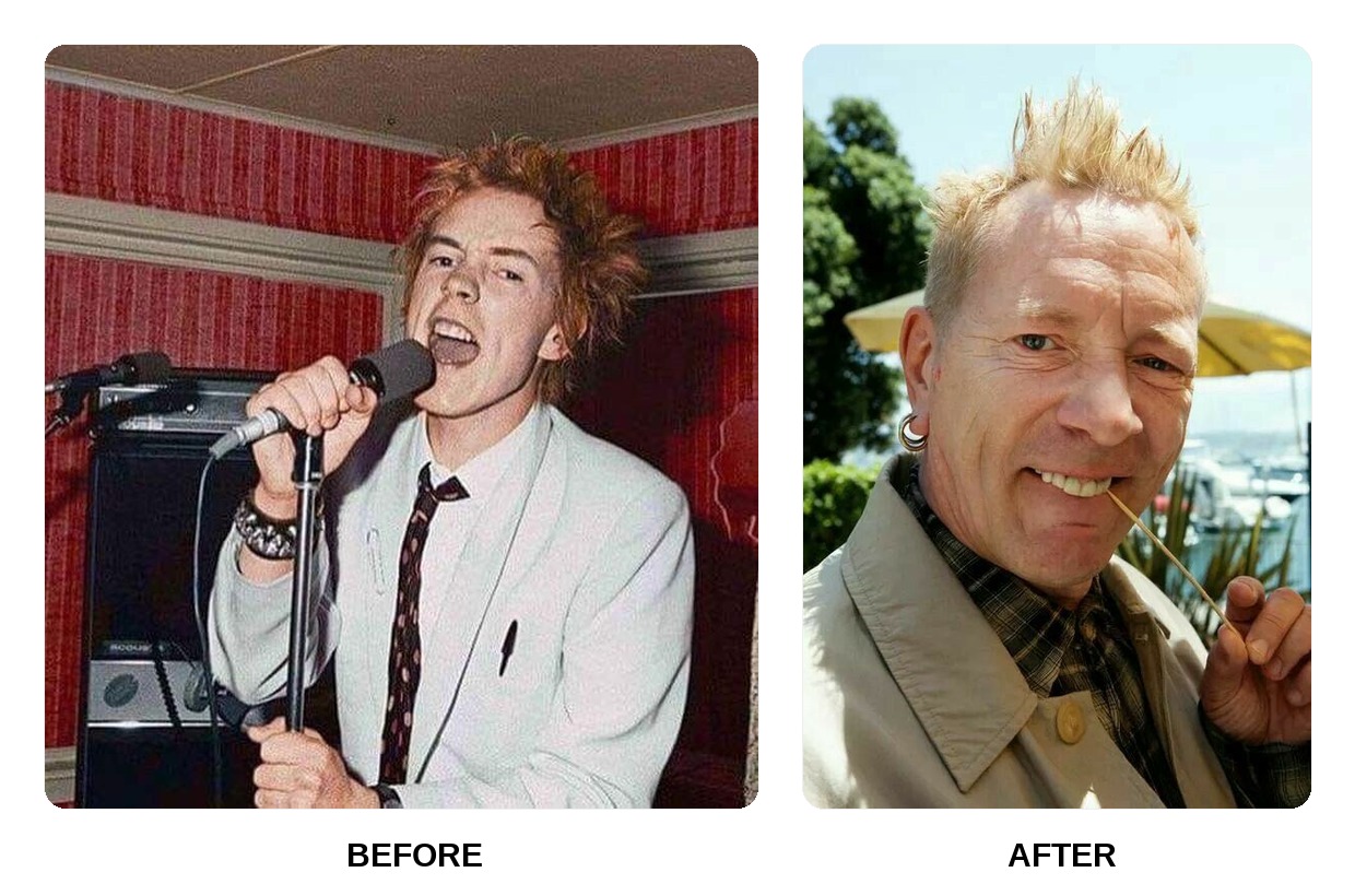 Johnny Rotten’s Teeth Before and After: What Happened in His Transformation?