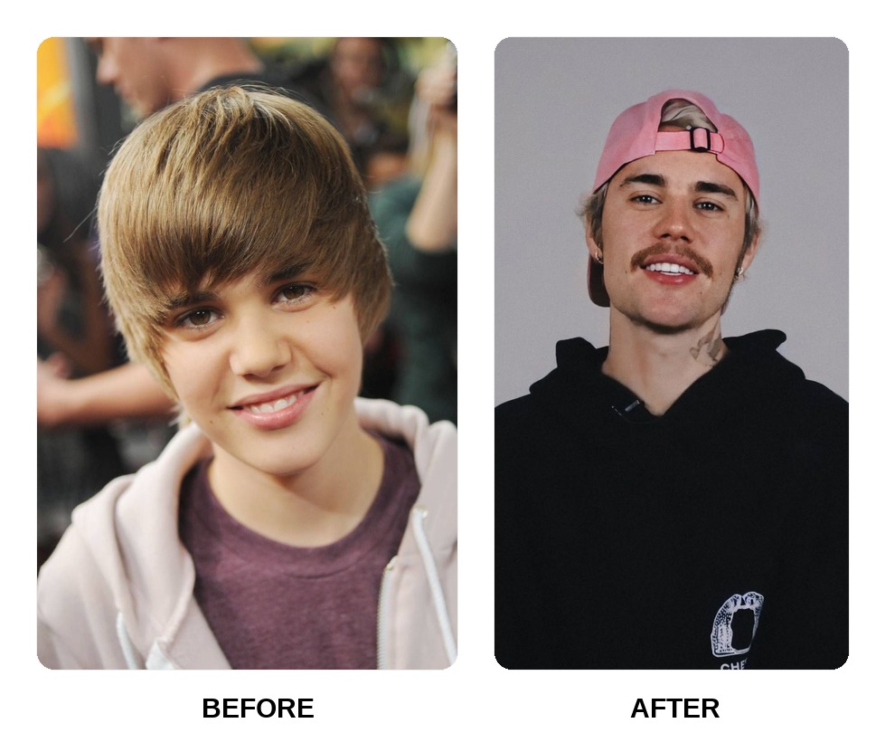 Justin Bieber Teeth Before and After: What Happened in His Transformation?