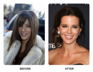 Tom Hardy Teeth Before and After: What Happened in His Transformation