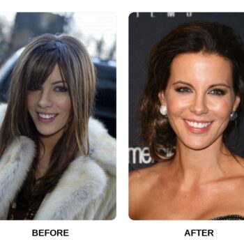 Kate Beckinsale Teeth Before and After: What Happened in Her Transformation?