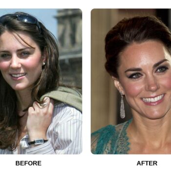 Kate Middleton Teeth Before and After: What Happened in Her Transformation?
