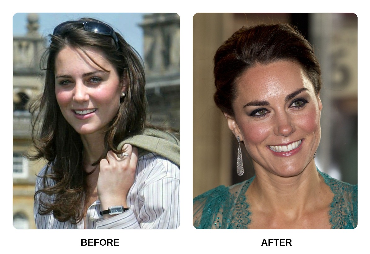 Kate Middleton Teeth Before and After: What Happened in Her Transformation?