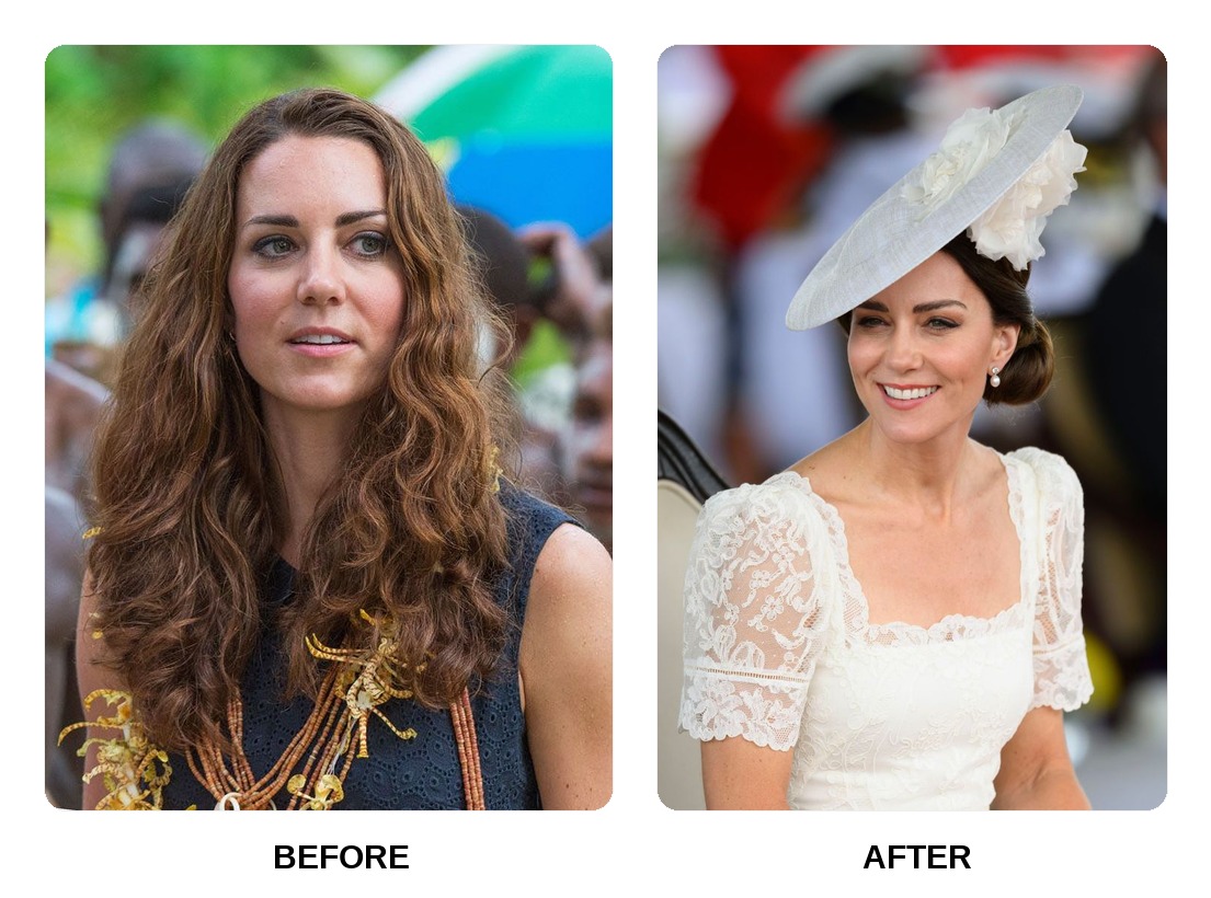 Kate Middleton teeth in her youth