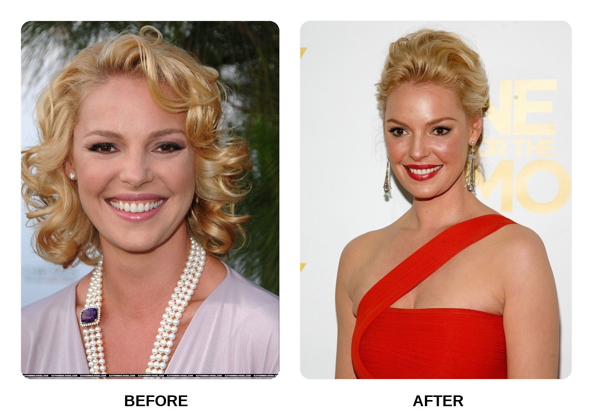 Katherine Heigl teeth in her youth