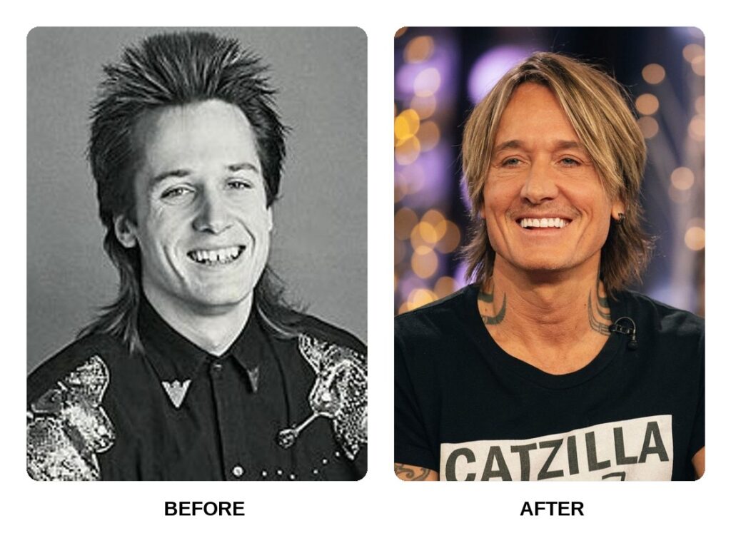 Keith Urban Teeth Before and After: What Happened in His Transformation?