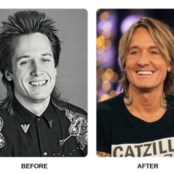 Keith Urban Teeth Before and After: What Happened in His Transformation?