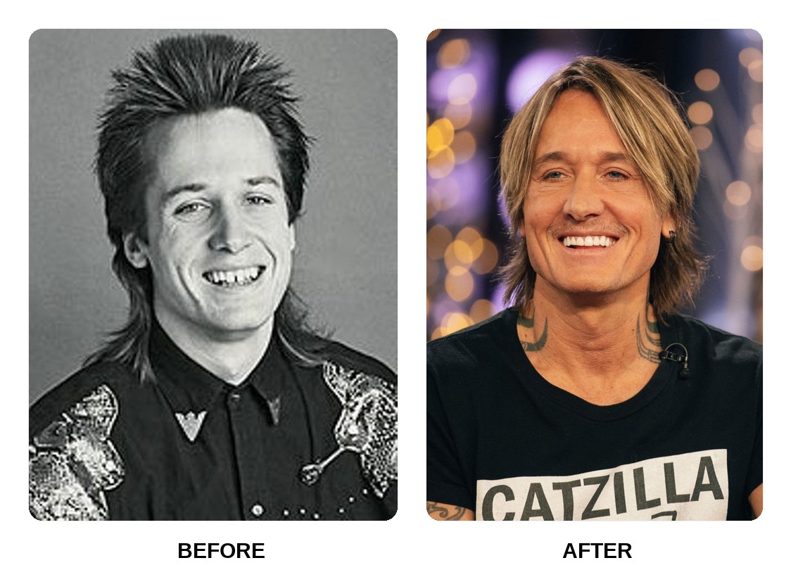 Keith Urban Teeth Before and After: What Happened in His Transformation?
