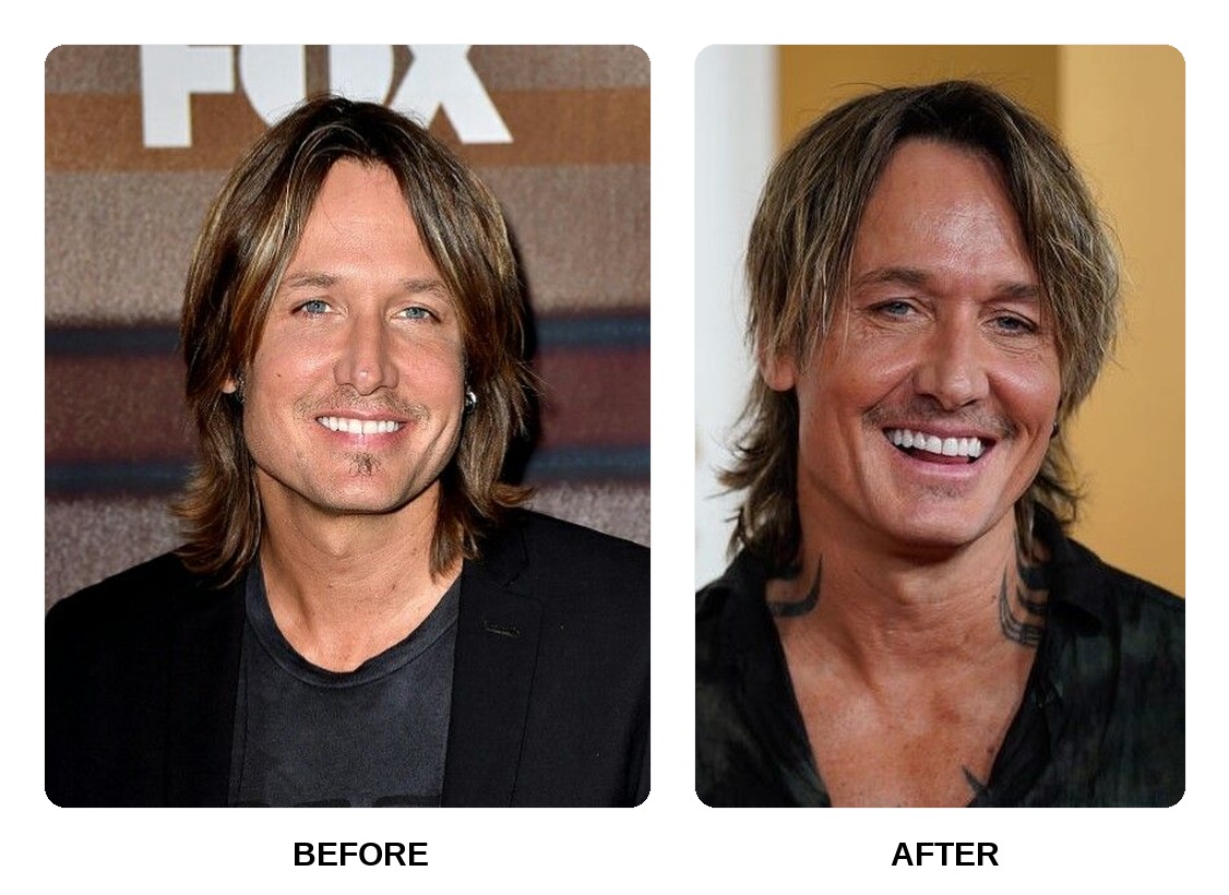 Keith Urban teeth in his youth