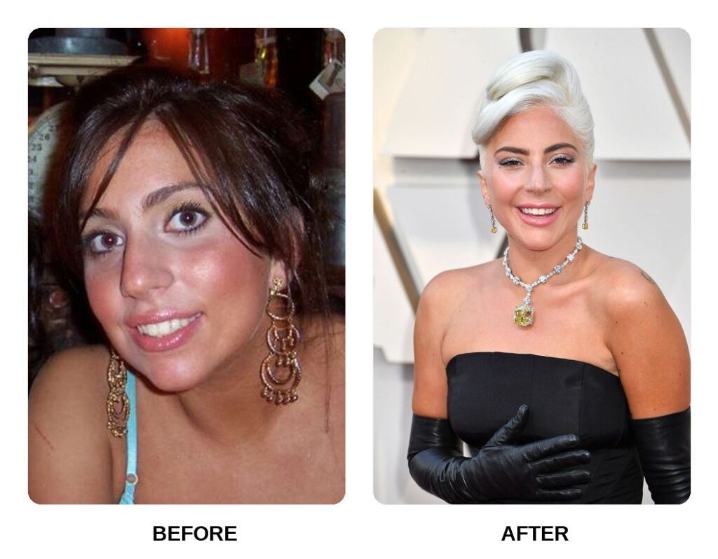 Lady Gaga Teeth Before and After: What Happened in Her Transformation?